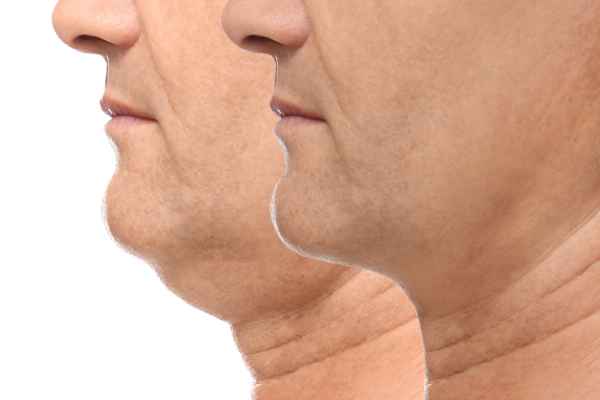 HIFU - Breakthrough in Anti - ageing 2 hifu results Nottingham