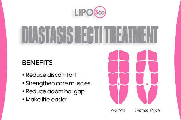 Revolutionising Muscle Repair: The Power of LIPO360 Body Sculpt Post-Injury 5 diastasis recti treatment Nottingham