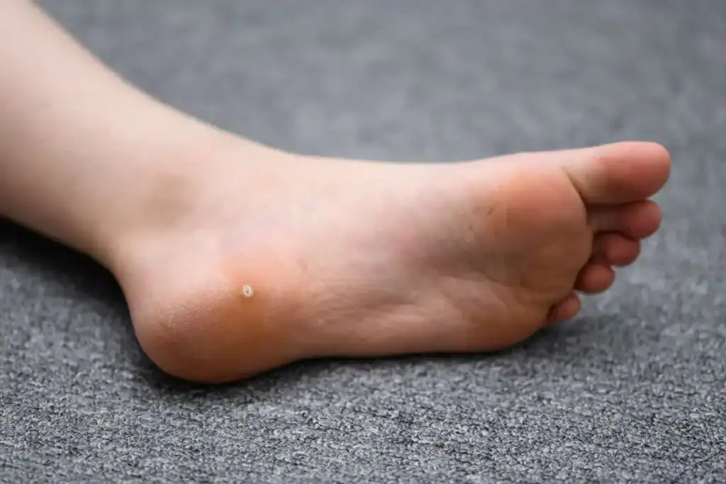 Cryotherapy For Warts And Also Verrucas 2 Image of verruca on the bottom of the foot that able to be treated with Cryotherapy Nottingham