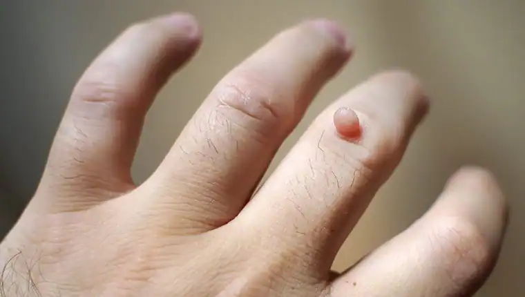 Cryotherapy For Warts And Also Verrucas 1 Image of blemish that Cryotherapy Nottingham can remove with Lipo 360.