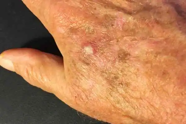 Image of Actinic keratoses Nottingham on a person hand