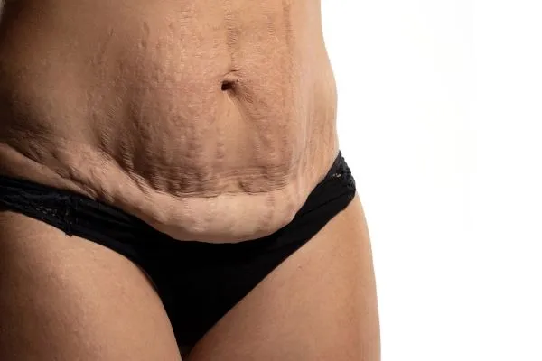 The Science of Skin Tightening 1 The science behind skin tightening Nottingham picture of a woman's sagging skin on the stomach